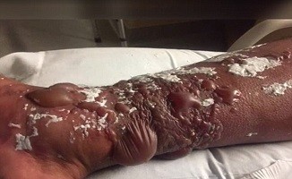 bactéria comedora de carne bactéria comedora de carne