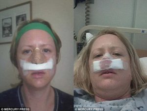 bactéria comedora de carne humana