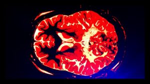 Adrenoleucodistrofia