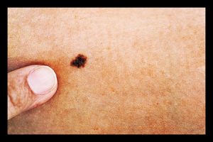 tratamento de melanoma