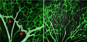 telangiectasia hemorrágica