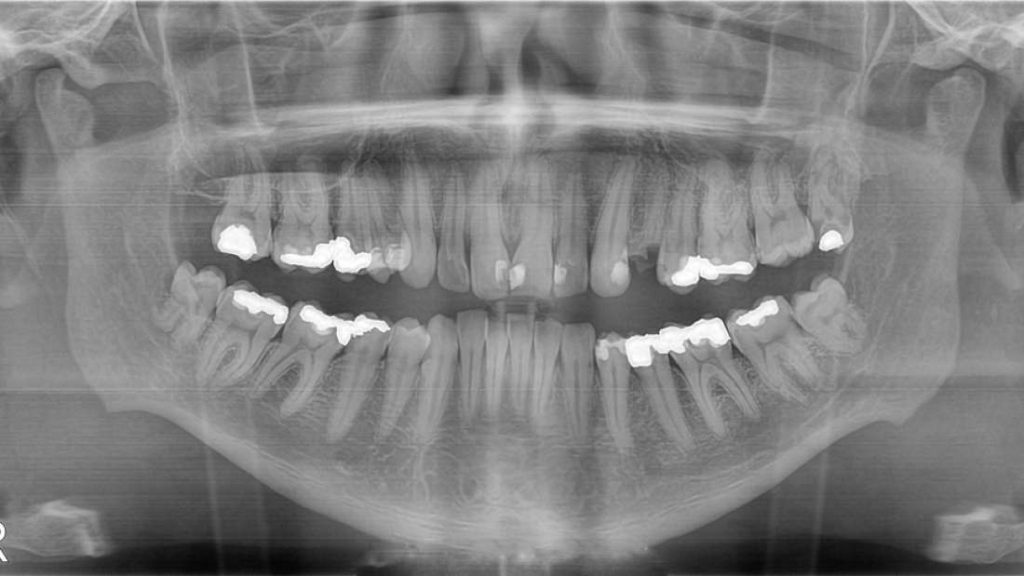Remédio contra Alzheimer pode ser usado para regeneração natural de dentes