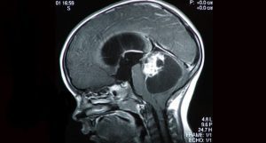 câncer cerebral pediátrico