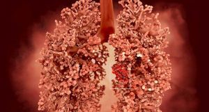 câncer de pulmão Exercícios respiratórios