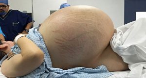 o maior cisto de ovário do mundo