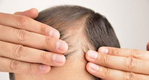 curar calvície