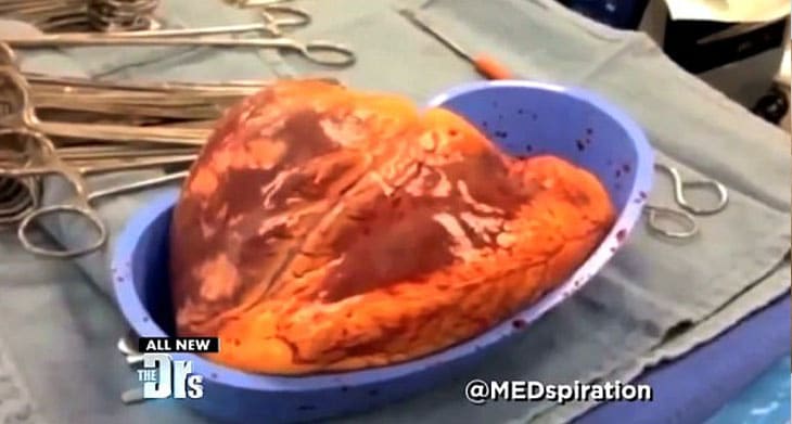 Vídeo mostra como o uso de cocaína a longo prazo pode afetar o coração