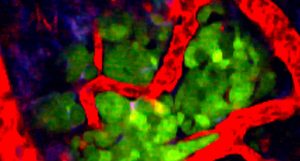 metástase em câncer