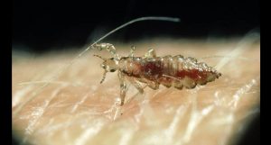 cabelo infestado de piolho