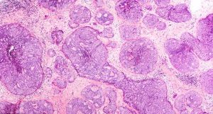 metástases nos pulmões