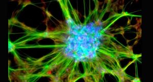 doença de Parkinson