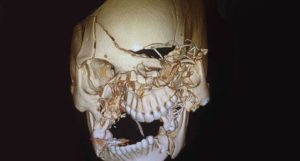 reconstrução facial