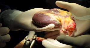 transplante de coração