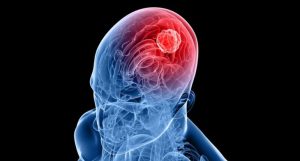 tumor cerebral