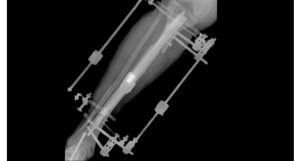 cirurgia para aumentar altura
