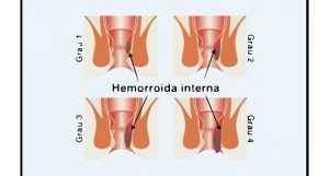 hemorroida