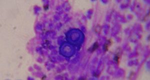 infecção por fungo