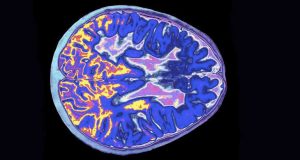 causar esclerose múltipla