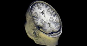 bactérias no cérebro