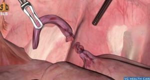 remoção de apêndice