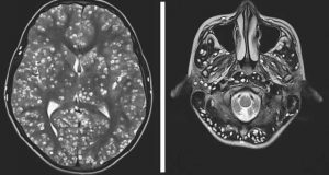 infecção parasitária