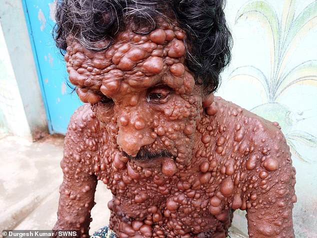 Neurofibromatose
