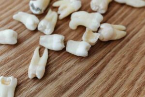 Mandíbula esqueletizada com vista dos dentes e arame de ouro enrolado em torno de duas peças dentárias